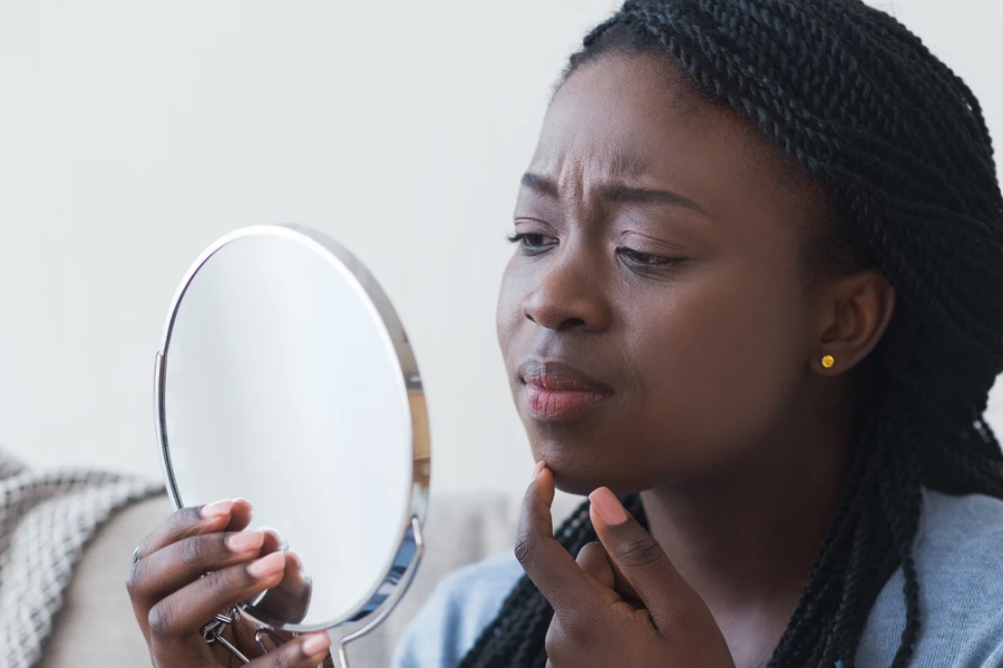 Acne – “a doença de espinhas na cara” – causas e tratamento