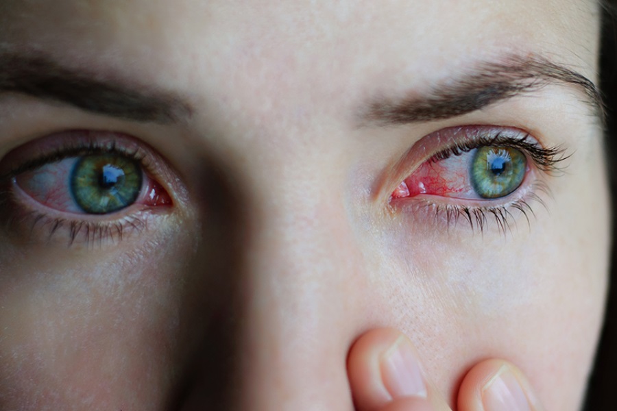 Coronavírus: Olhos vermelhos