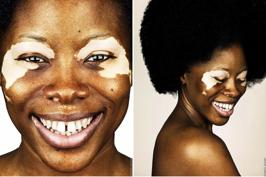 Vitiligo: A beleza da imperfeição