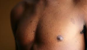 Saude: Esta alteração na pele pode indicar que sofre de cancro da mama