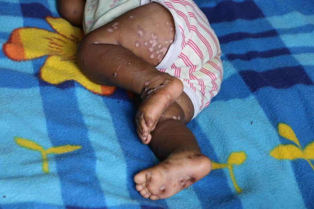 Saúde: 5 mitos sobre o vírus da varíola do macaco