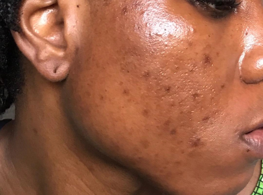 Saúde/acne hormonal: tudo o que precisa de saber para se ver livre dela