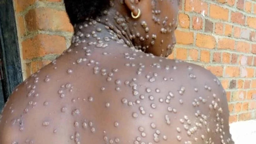Moçambique/Sociedade: Moçambique regista sete novos casos de mpox e reforça controlo nas fronteiras com o Maláui